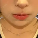 ヒアルロン酸注入（あご） / ボトックス（エラ・小顔） ルラ美容クリニック 名古屋本院 DAY 0 サムネイル用