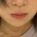 ヒアルロン酸注入（あご） / ボトックス（エラ・小顔） ルラ美容クリニック 名古屋本院 AFTER サムネイル用