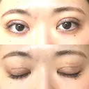 二重切開 EMMA CLINIC（エマクリニック） DAY 10 サムネイル用