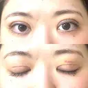 二重切開 EMMA CLINIC（エマクリニック） DAY 7 サムネイル用