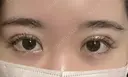 二重埋没 大塚美容形成外科 銀座本院 AFTER サムネイル用