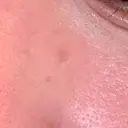 ほくろ・いぼ除去レーザー（肌） 心斎橋KT美容クリニック AFTER サムネイル用