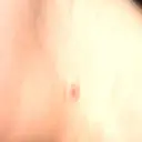 ほくろ・いぼ除去レーザー（肌） 心斎橋KT美容クリニック DAY 13 サムネイル用