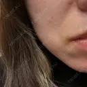 ピーリング（ハリ・ツヤ） ジュエルクリニック 恵比寿院 AFTER サムネイル用