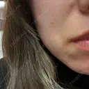 ピーリング（ハリ・ツヤ） ジュエルクリニック 恵比寿院 DAY 0 サムネイル用