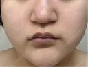 脂肪溶解注射（顔） ミニマムスキンクリニック池袋 DAY 1 サムネイル用