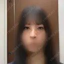 目頭切開 / 小鼻縮小（切開） / 鼻尖形成（非切開） アネシス美容クリニック AFTER サムネイル用