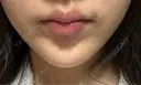 ボトックス（あご） / ボトックス（口角） / ボトックス（眉間） 上野注入クリニック DAY 10 サムネイル用