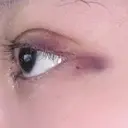 二重埋没 / 目頭切開 / 上まぶたの脂肪取り 9BeautyClinic DAY 3 サムネイル用