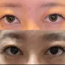 脂肪吸引（顔） / 目尻切開 / タレ目形成・グラマラスライン（埋没） LOUIS CLINIC 二子玉川院【ルイクリニック】 DAY 4 サムネイル用