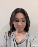 糸リフト / 脂肪吸引（顔） Wing clinic 豊中駅前院 AFTER サムネイル用