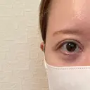 下まぶたたるみ取り / その他（目元） ネビュラクリニック 京都院 DAY 22 サムネイル用