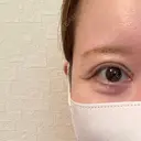 下まぶたたるみ取り / その他（目元） ネビュラクリニック 京都院 DAY 22 サムネイル用