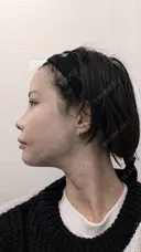 糸リフト / 脂肪吸引（顔） / その他（輪郭） / ジョールファット除去 WOM CLINIC GINZA （ワム クリニック ギンザ） DAY 47 サムネイル用