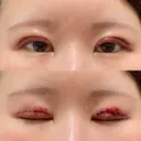 二重切開 東京エビスクリニック DAY 0 サムネイル用