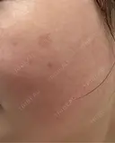 その他（肌） / シミ取りレーザー / ルメッカ ルラ美容クリニック 郡山院 DAY 44 サムネイル用