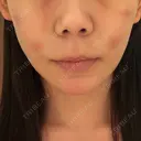 糸リフト / 脂肪吸引（顔） / 脂肪注入（額） / メーラーファット除去 / ジョールファット除去 First Clinic DAY 1 サムネイル用