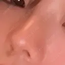 鼻尖形成（切開） / その他（鼻） / 軟骨移植 / 鼻柱下降・鼻唇角形成（猫手術） 東京美専クリニック DAY 65 サムネイル用