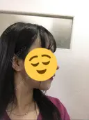 バッカルファット除去 / 脂肪吸引（顔） / ボトックス（エラ・小顔） / ヒアルロン酸注入（額） エートップ美容整形外科 DAY 96 サムネイル用