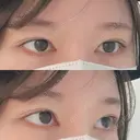 目頭切開 東京シンデレラ美容外科 池袋院 AFTER サムネイル用