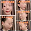 バッカルファット除去 / その他（輪郭） / 切開リフト / メーラーファット除去 / ジョールファット除去 / あご下筋肉縛り / ネックリフト / ヒアルロン酸注入（頬） / ヒアルロン酸注入（首） タシピウム整形外科 DAY 334 サムネイル用