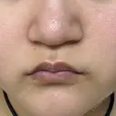 脂肪溶解注射（顔） ミニマムスキンクリニック池袋 DAY 4 サムネイル用