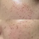 ピーリング（ニキビ・毛穴） / イオン導入 / ルメッカ ルラ美容クリニック 札幌本院 DAY 0 サムネイル用