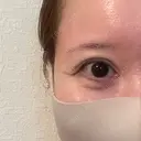 下まぶたたるみ取り / その他（目元） ネビュラクリニック 京都院 DAY 93 サムネイル用