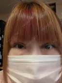 二重埋没 湘南美容クリニック 千葉センシティ院 DAY 3 サムネイル用