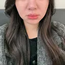 糸リフト / バッカルファット除去 / 脂肪吸引（顔） / メーラーファット除去 / ジョールファット除去 / 脂肪注入（輪郭） First Clinic AFTER サムネイル用