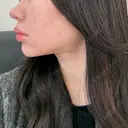 糸リフト / バッカルファット除去 / 脂肪吸引（顔） / メーラーファット除去 / ジョールファット除去 / 脂肪注入（輪郭） First Clinic DAY 106 サムネイル用