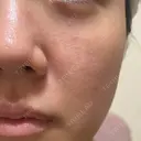 ヴェルヴェットスキン 形成外科と美容外科のクリニック池袋 DAY 43 サムネイル用