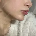 ボトックス（あご） / ヒアルロン酸注入（あご） HAAB BEAUTY CLINIC 名古屋院 DAY 1 サムネイル用