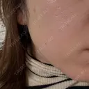 ピーリング（ニキビ・毛穴） / LDM・インテンスウルトラ ライズワン美容皮膚科クリニック DAY 0 サムネイル用