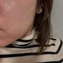 ピーリング（ニキビ・毛穴） / LDM・インテンスウルトラ ライズワン美容皮膚科クリニック DAY 0 サムネイル用