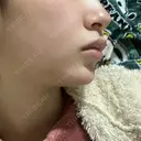 ボトックス（あご） / ヒアルロン酸注入（あご） HAAB BEAUTY CLINIC 名古屋院 AFTER サムネイル用