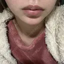 ボトックス（あご） / ヒアルロン酸注入（あご） HAAB BEAUTY CLINIC 名古屋院 DAY 5 サムネイル用