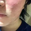 フラクショナルレーザー（毛穴・ニキビ跡） ルラ美容クリニック 大阪本院 DAY 1 サムネイル用