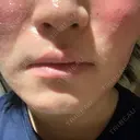 フラクショナルレーザー（毛穴・ニキビ跡） ルラ美容クリニック 大阪本院 DAY 1 サムネイル用