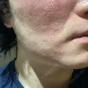 フラクショナルレーザー（毛穴・ニキビ跡） ルラ美容クリニック 大阪本院 AFTER サムネイル用