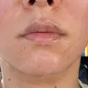糸リフト 城本クリニック 豊橋院 DAY 2 サムネイル用