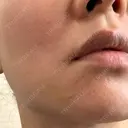 糸リフト 城本クリニック 豊橋院 DAY 4 サムネイル用