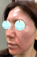 ピコレーザートーニング（美白・肝斑） / ピコフラクショナルレーザー（毛穴・ニキビ跡） / ピコスポット 東京シルククリニック 新宿院 DAY 0 サムネイル用