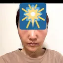 糸リフト / クマ治療 / 下まぶたたるみ取り / 脂肪注入（目の下） / ボトックス（あご） / その他（口元） アリエル美容クリニック 水戸院 DAY 14 サムネイル用