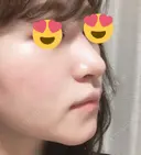 隆鼻術 / 鼻尖形成（切開） / 鼻中隔延長（切開） / 斜鼻修正 / 眉間プロテーゼ / その他（鼻） FROM B整形外科 (旧バウム整形外科) AFTER サムネイル用