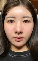 糸リフト / バッカルファット除去 / 脂肪吸引（顔） / 脂肪注入（額） / ジョールファット除去 First Clinic DAY 14 サムネイル用