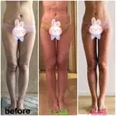 脂肪吸引（脚） / 脂肪吸引（お腹） / 脂肪吸引（お尻） ラインカルチャークリニック DAY 50 サムネイル用