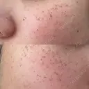 ピーリング（ニキビ・毛穴） / イオン導入 / ルメッカ ルラ美容クリニック 札幌本院 DAY 3 サムネイル用