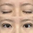二重埋没 / 上まぶたの脂肪取り アリエル美容クリニック 郡山院 DAY 21 サムネイル用