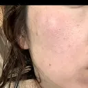 ピーリング（ニキビ・毛穴） / LDM・インテンスウルトラ ライズワン美容皮膚科クリニック DAY 3 サムネイル用